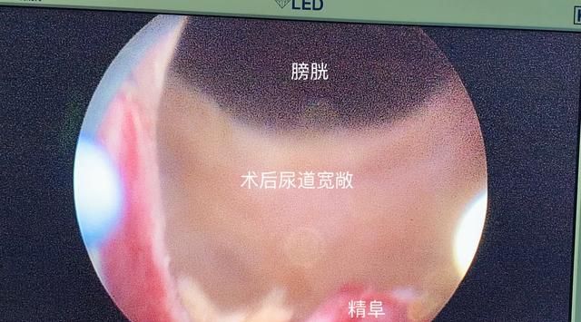 前列腺炎治疗效果如何图2