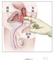 什么检查前列腺需要经直肠指检图2