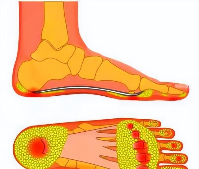 中老年人脚底板疼痛，究竟是啥问题？不出意外，6种可能性最大