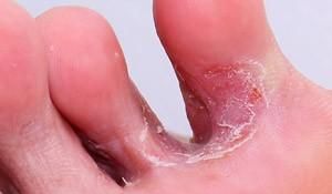 皮肤科医生和你聊脚气：脚气为什么容易反复，该如何预防和治疗