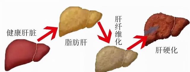 血吸虫肝硬化