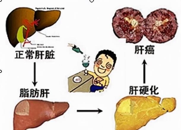血吸虫肝硬化