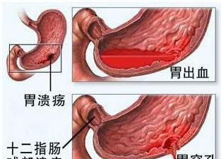 胃出血的危害，大家一定要预防好了