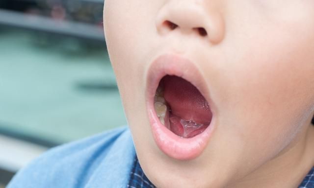 什么是舌系带？舌系带过短是怎么回事？发音不清要割舌系带吗？