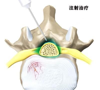 腰痛药物治疗首选图5