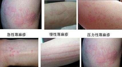 胆碱能性荨麻疹的临床表现及治疗