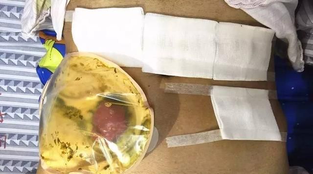 肠癌造口手术后，如何正确饮食，能有助于身体恢复？
