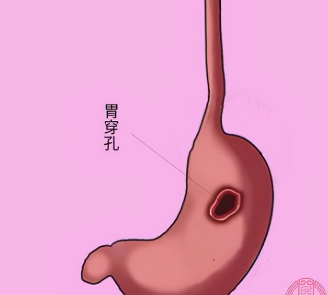 胃穿孔死亡率怎么样