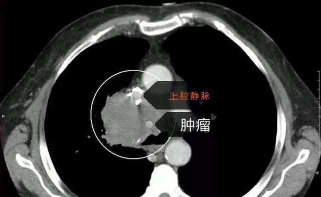 一文盘点：肺癌会有哪些“报警症状”？