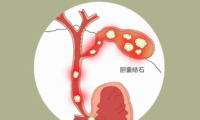 胆囊息肉，饮食要注意什么？医生给你讲讲，照着吃不会错