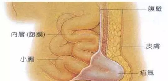 “疝气”到底是个啥？今天这里讲清楚