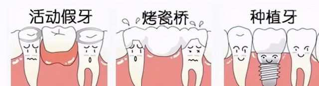 超强种植牙全过程！相当详细，值得一看#雅悦齿科#