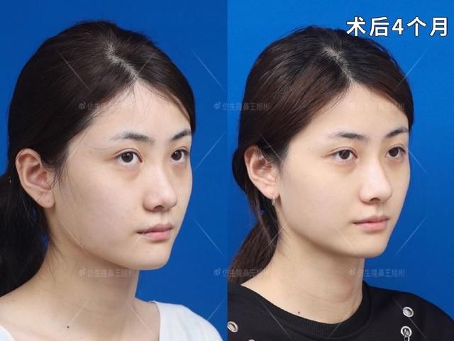 常见鼻整形项目案例合集！看完这篇，你也会“看鼻”了
