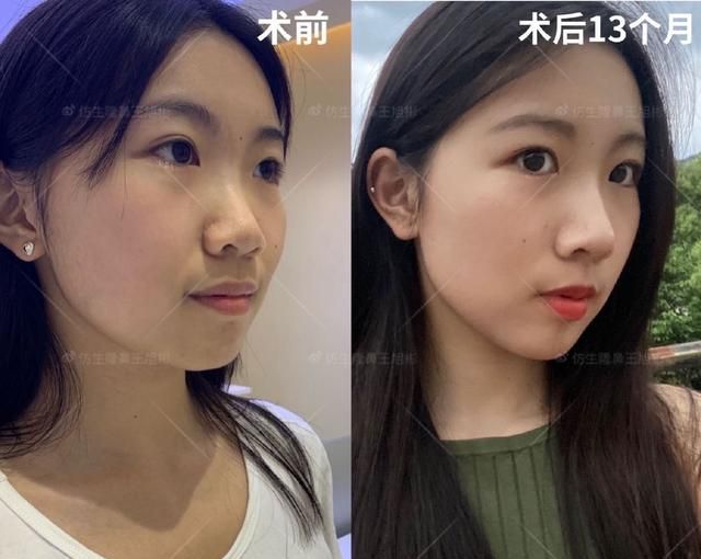 常见鼻整形项目案例合集！看完这篇，你也会“看鼻”了