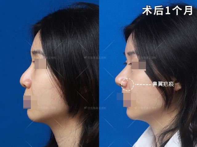 常见鼻整形项目案例合集！看完这篇，你也会“看鼻”了