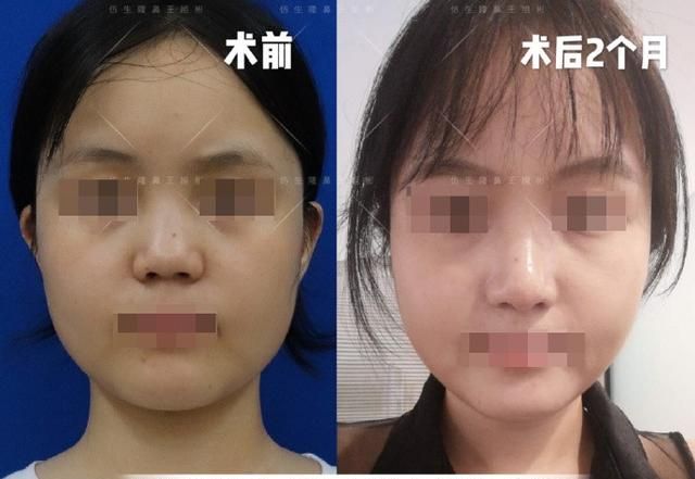常见鼻整形项目案例合集！看完这篇，你也会“看鼻”了