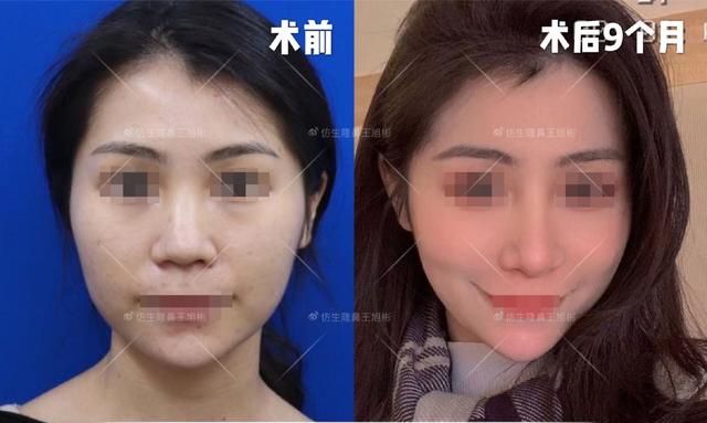 常见鼻整形项目案例合集！看完这篇，你也会“看鼻”了