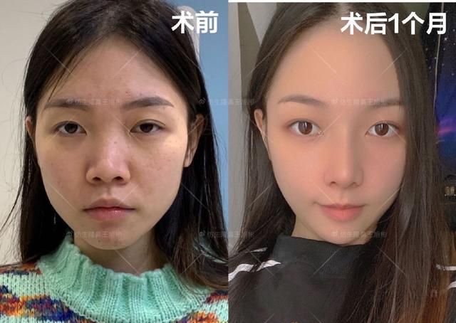 常见鼻整形项目案例合集！看完这篇，你也会“看鼻”了