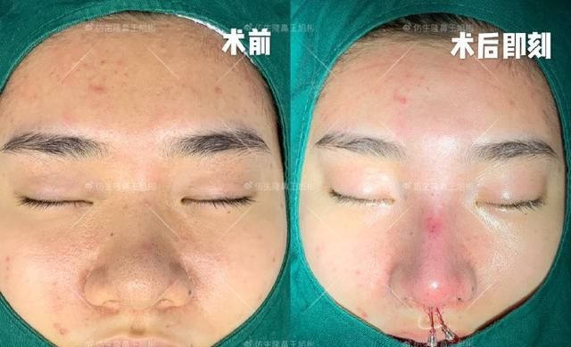 常见鼻整形项目案例合集！看完这篇，你也会“看鼻”了