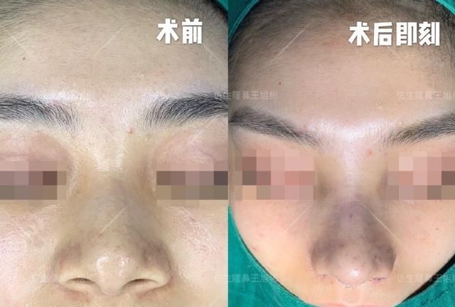 常见鼻整形项目案例合集！看完这篇，你也会“看鼻”了