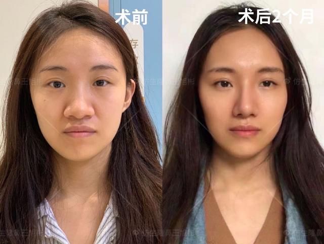 常见鼻整形项目案例合集！看完这篇，你也会“看鼻”了