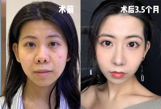 常见鼻整形项目案例合集！看完这篇，你也会“看鼻”了