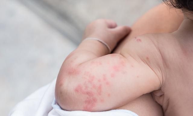 要想解决荨麻疹这个难题，你先得了解其7大诱因，对症治疗是关键