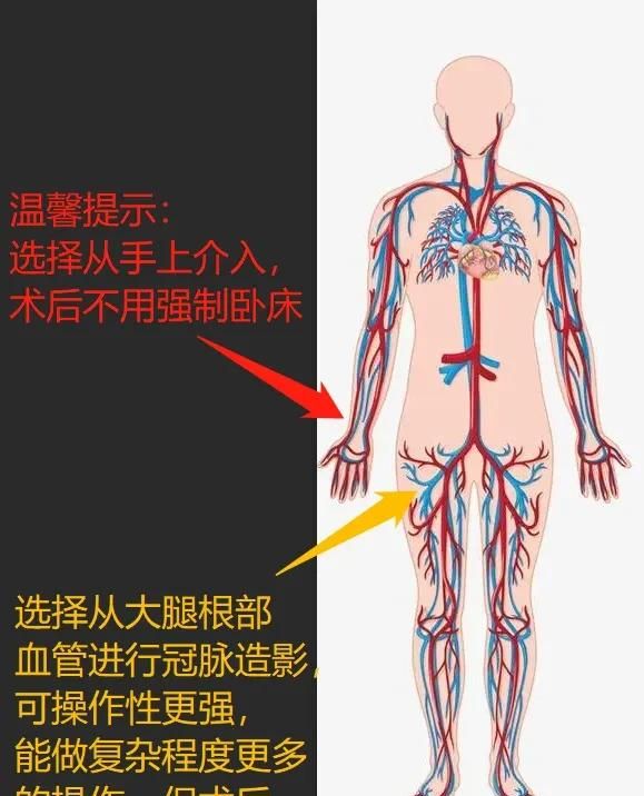 冠脉造影是怎么做的,对身体影响大吗?图1