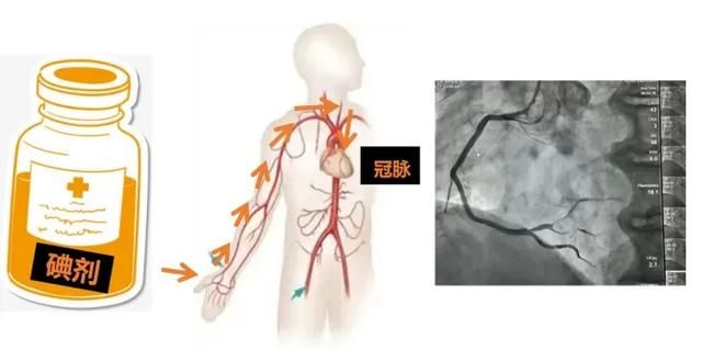 冠脉造影是怎么做的,对身体影响大吗?图2
