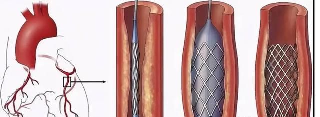 冠脉造影是怎么做的,对身体影响大吗?图5