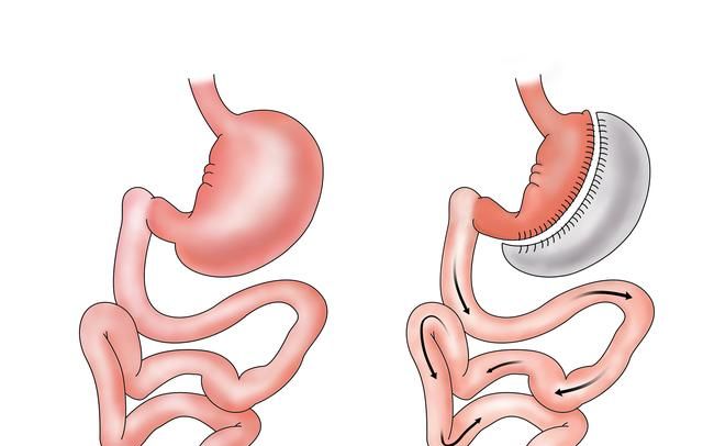 拿2/3的胃换30斤体重！减肥真要把胃切掉？手术没你想得那么可怕