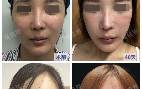 拉皮手术是什么样的,拉皮手术什么季节做拉皮好