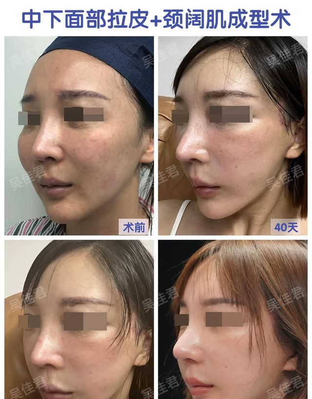 拉皮就是拉“皮”吗？拉皮手术到底是什么？