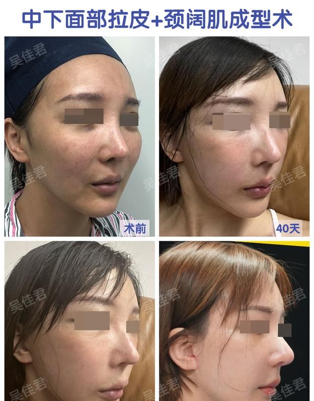 拉皮就是拉“皮”吗？拉皮手术到底是什么？