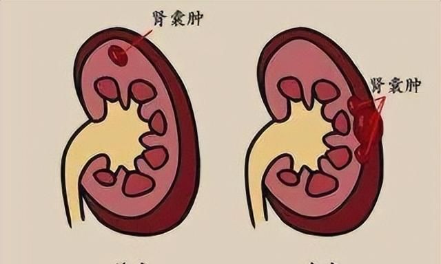体检时发现肾囊肿，严重吗？需采取哪些应对措施？望知晓