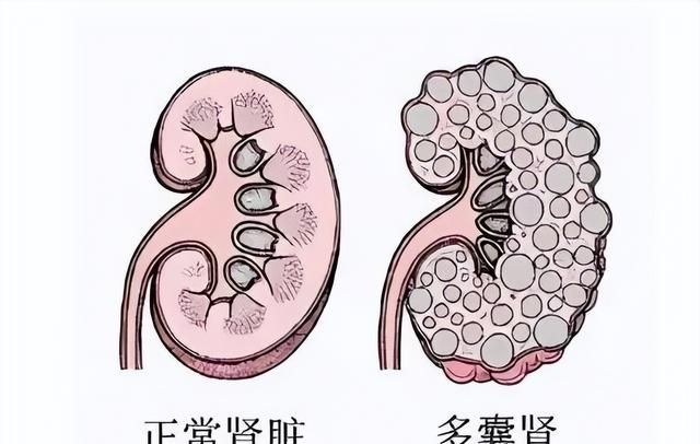 体检时发现肾囊肿，严重吗？需采取哪些应对措施？望知晓