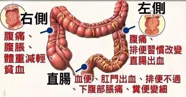 关于大肠癌，这是一篇最全面的科普