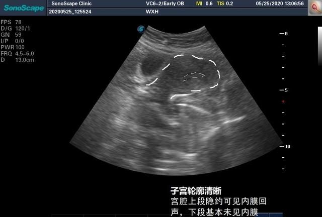 [临床案例]彩超引导下重度宫腔粘连分离手术