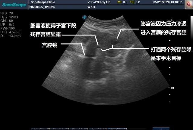 [临床案例]彩超引导下重度宫腔粘连分离手术