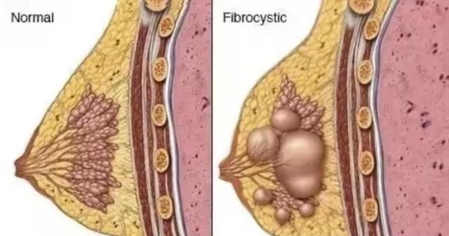 女性乳腺纤维腺瘤一例【武汉高尚医学影像】