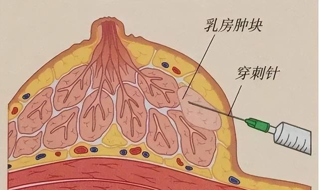 女性乳腺纤维腺瘤一例【武汉高尚医学影像】