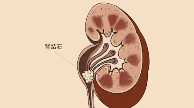 肾结石饮食大全