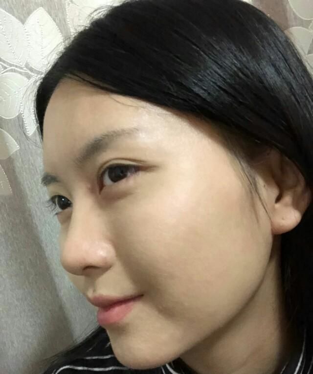 3.5万做了隆鼻，好看的鼻子真香！