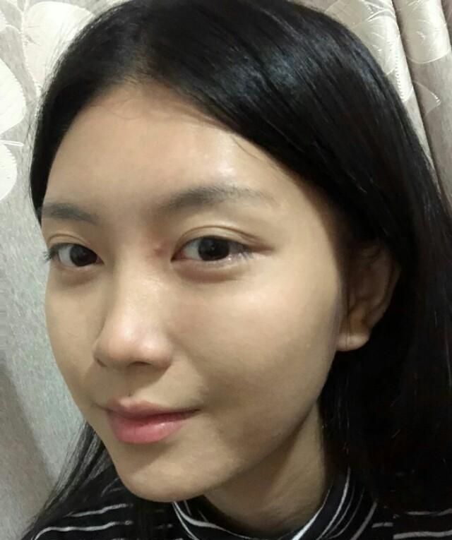 3.5万做了隆鼻，好看的鼻子真香！