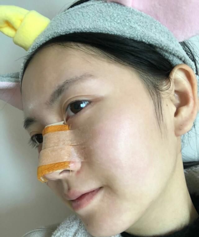 3.5万做了隆鼻，好看的鼻子真香！