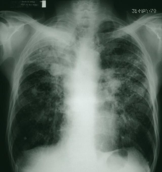 尘肺死亡率高达22.04%，大多数患者短期内病情加重，要警惕并发症