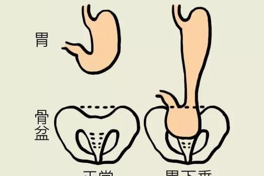 胃下垂不是病，只是胃比正常低，8个动作经常练可助恢复