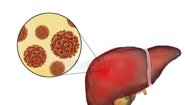 有了脂肪肝要怎么办，真的会变成肝癌吗？有什么方法可以逆转？