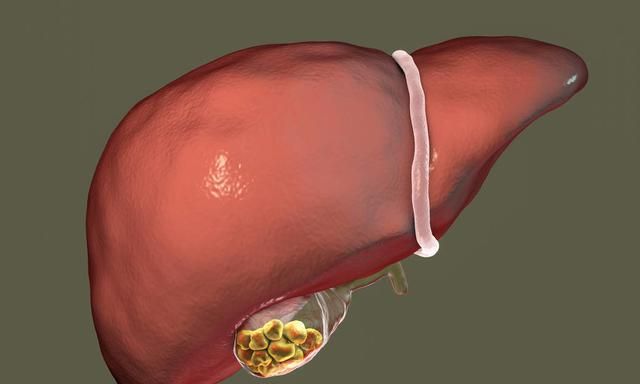 胆囊息肉、胆囊结石是怎么引起的？一个小检查揪出它们