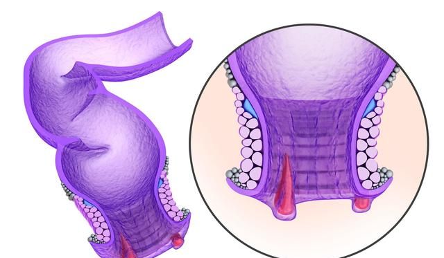 十人九痔，痔疮这4个危害，正在一步步“夺走”你的健康！